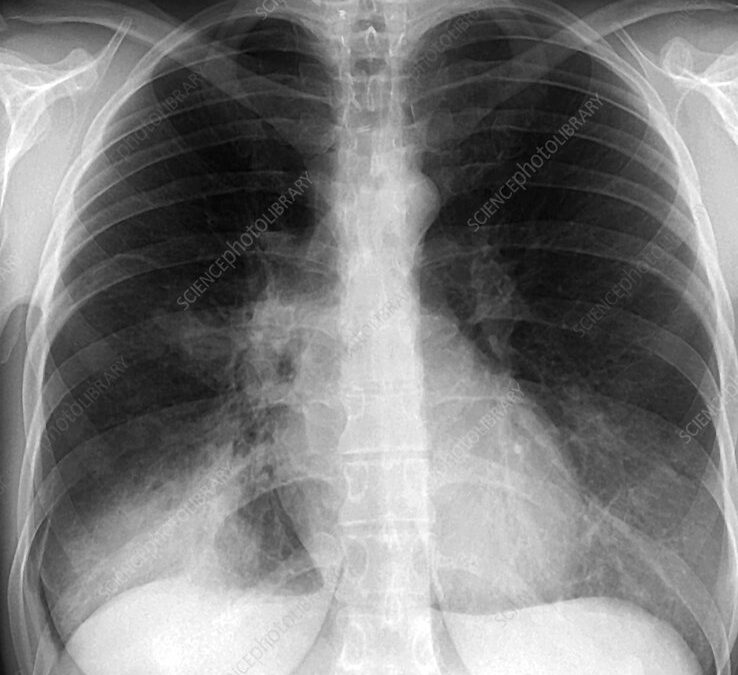 Chest Infection: Symptoms and Prevention