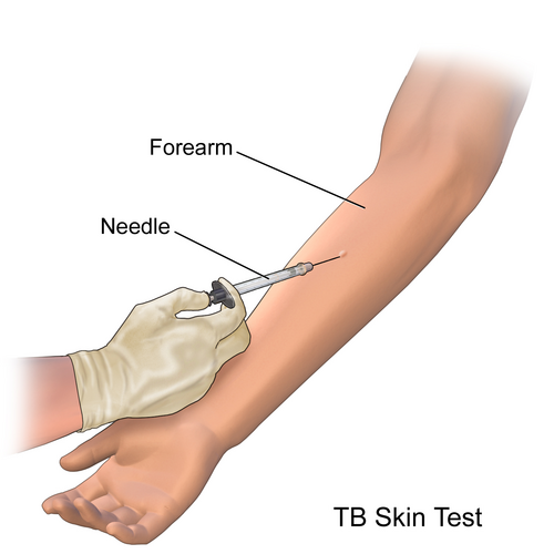 Mantoux TB Skin Test First Step Injection