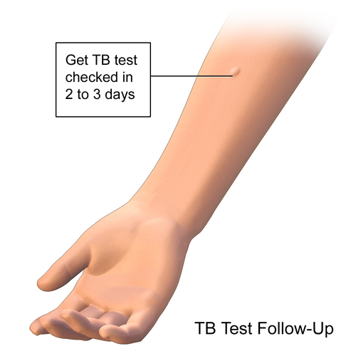 Mantoux TB Skin Test Followup Reading